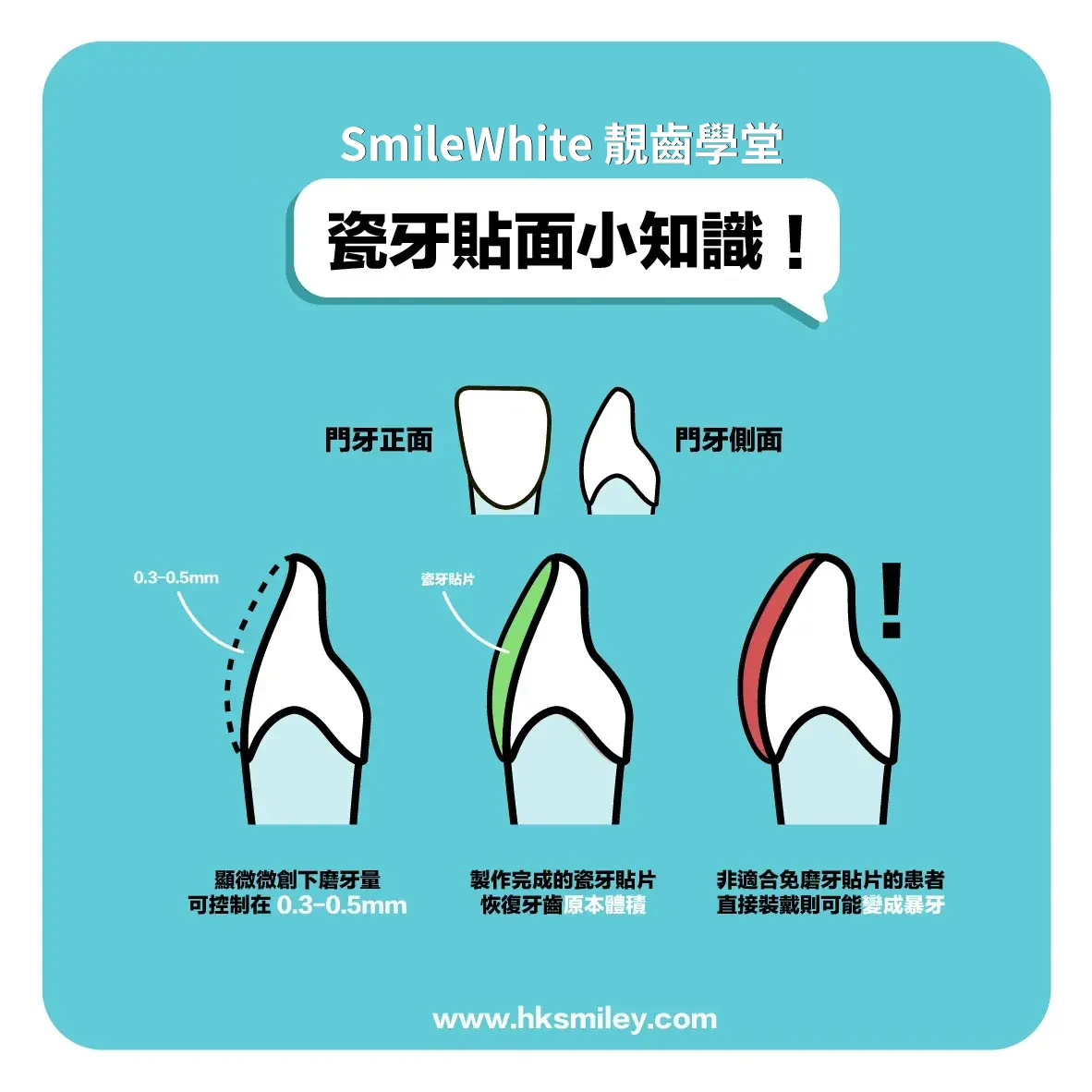 瓷牙貼面小知識：門牙正面與側面示意 —— 顯微微創下磨牙量可控制在 0.3-0.5mm；製作完成的瓷牙貼片恢復牙齒原本體積；非適合免磨牙貼片的患者直接裝戴則可能變成暴牙