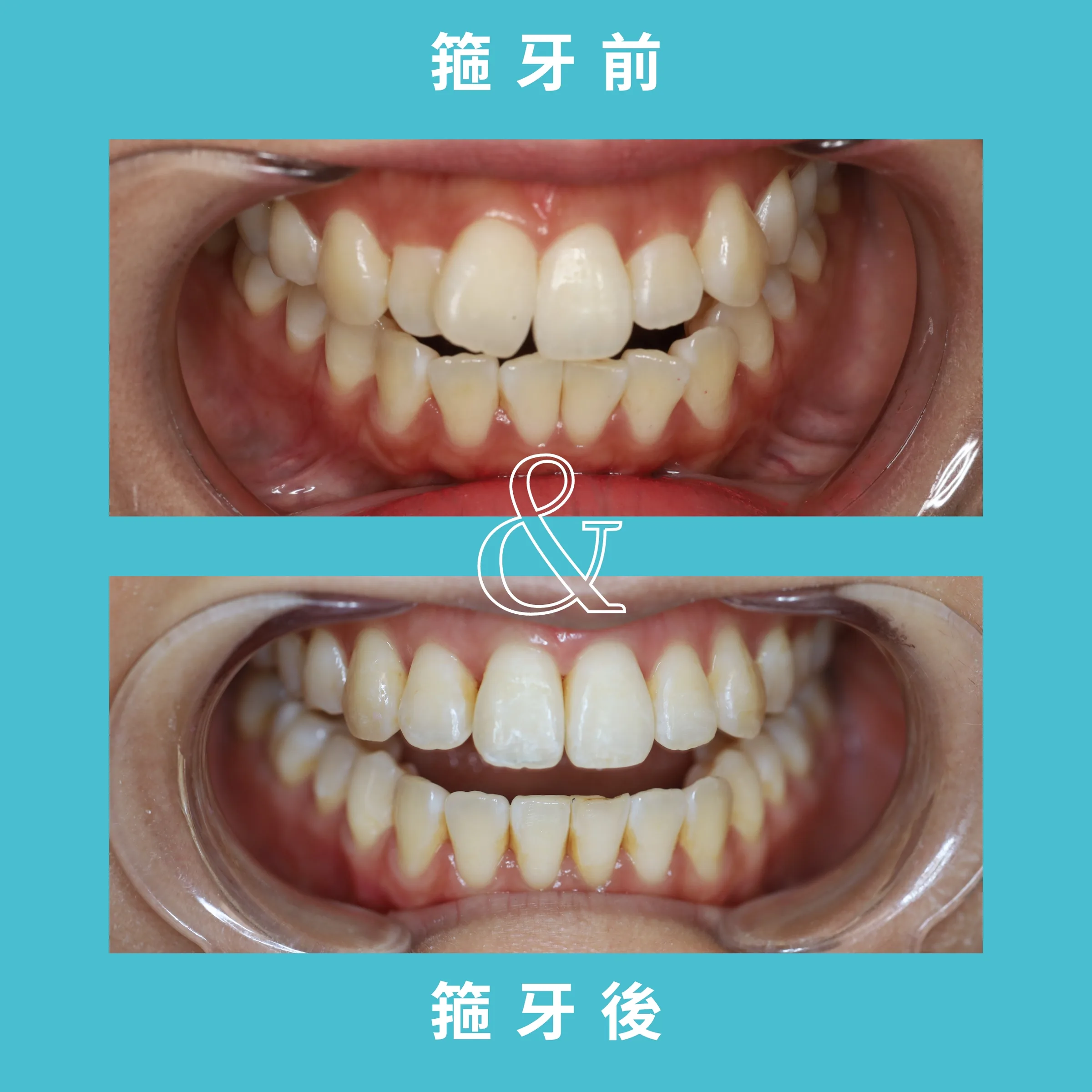 SMILE WHITE箍牙療程 案例 1