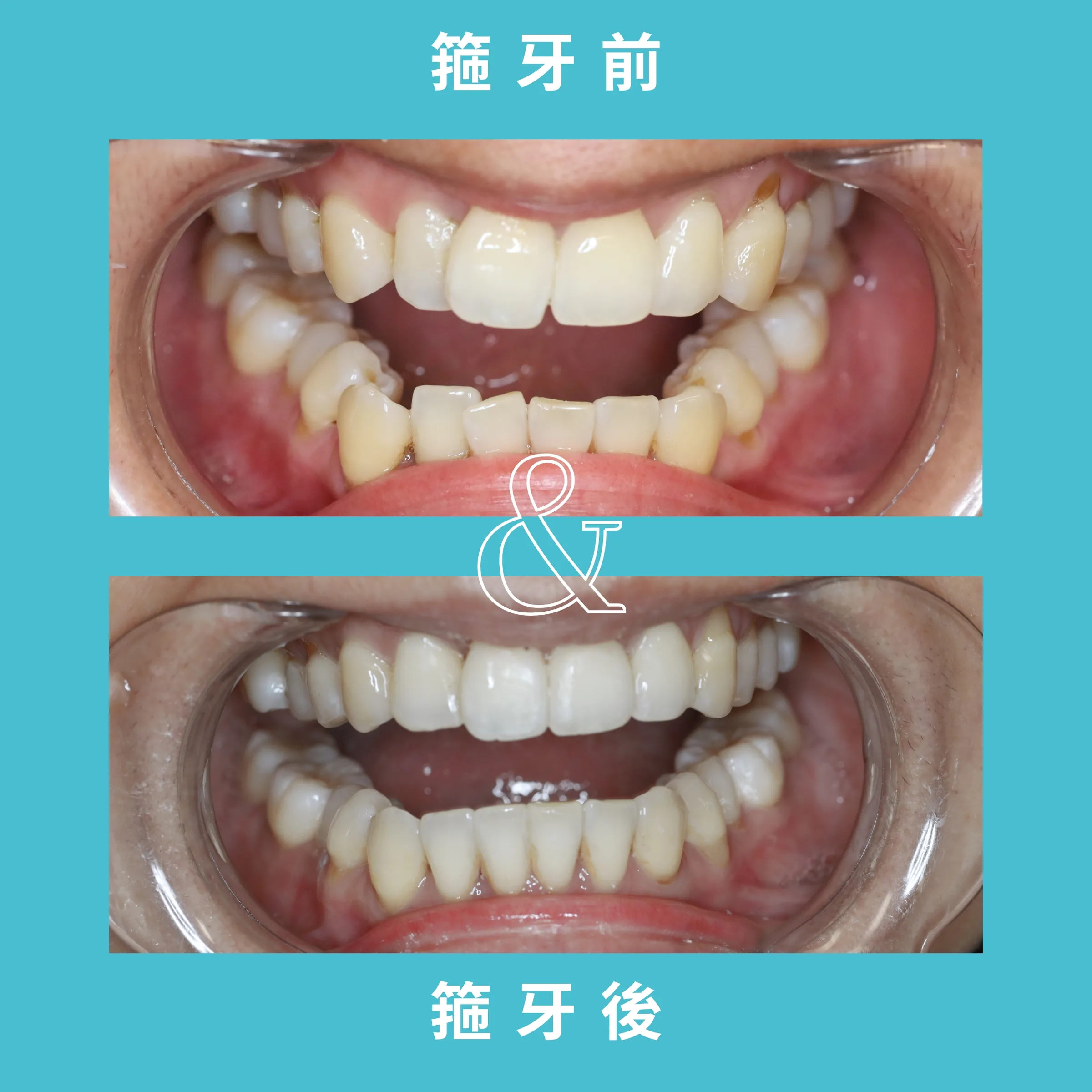 SMILE WHITE箍牙療程 案例 2