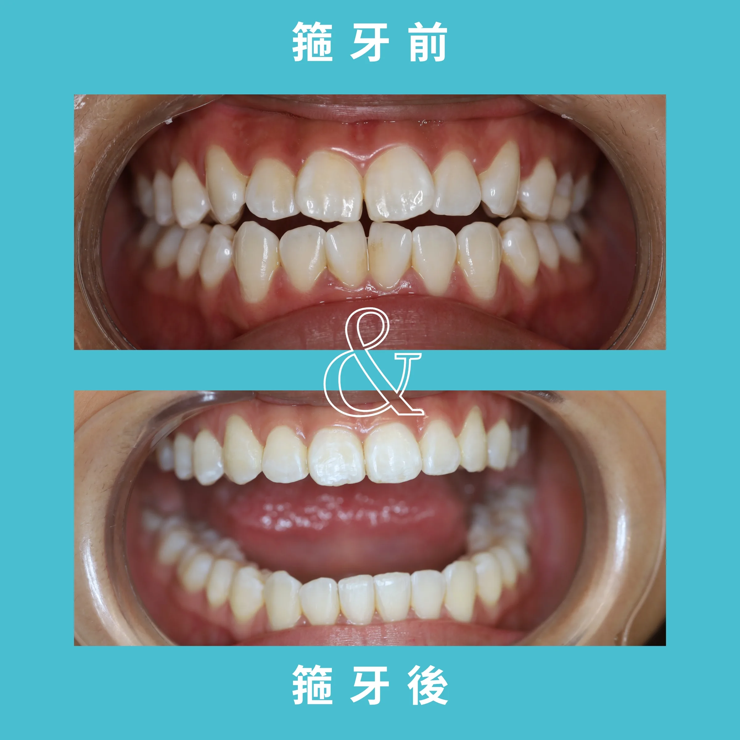 SMILE WHITE箍牙療程 案例 3