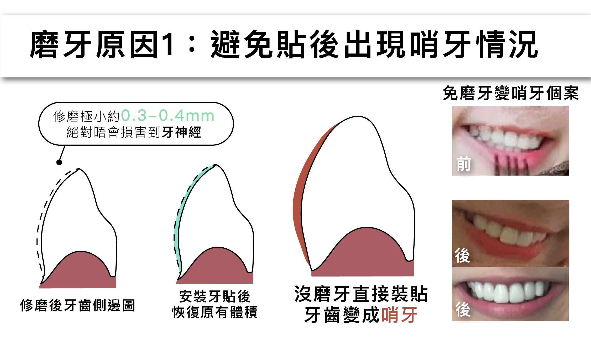 磨牙原因:避免牙貼後出現哨牙情況