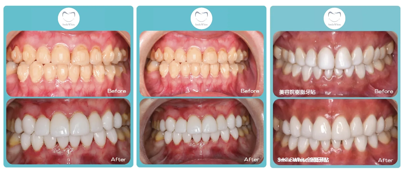 Smile White 全瓷牙貼真實案例 4 — 療程前後對比