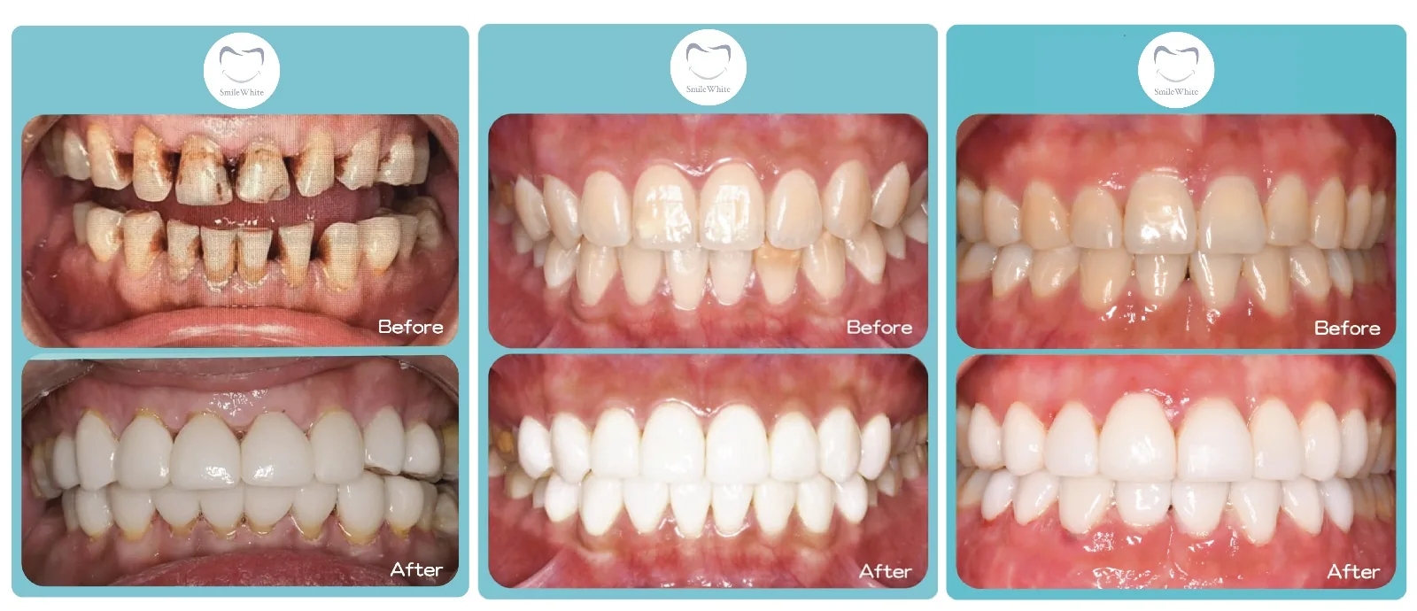 Smile White 全瓷牙貼真實案例 13 — 療程前後對比